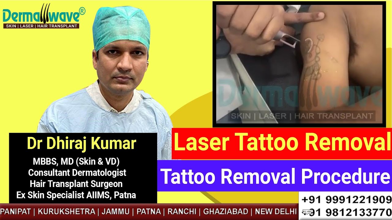 Tattoo Removal and Scar Treatment Specialist in NigdiBhosariMoshiPCMC   Dr Aishwarya PatilBest Skin Specialist in PCMC Pune