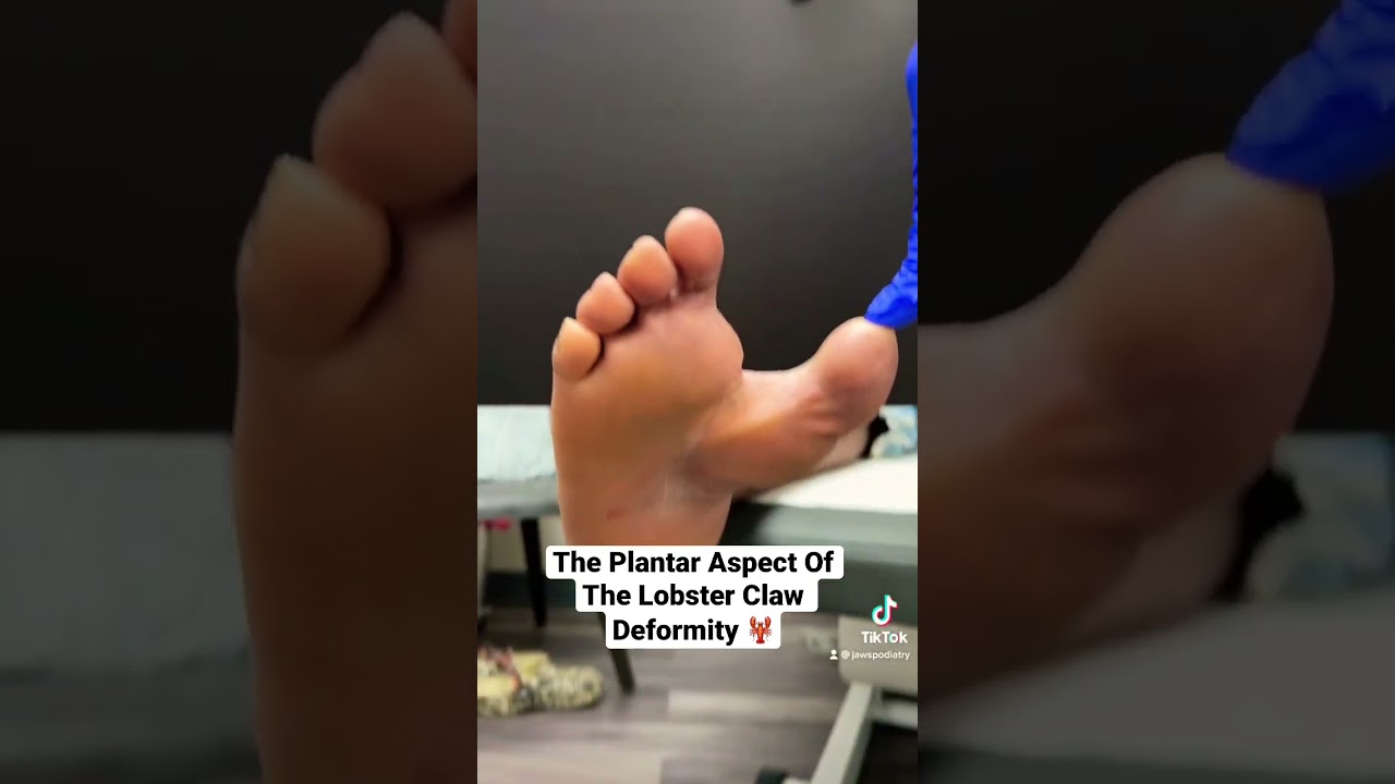 LOBSTER CLAW DEFORMITY Part 2 🦞shorts footsurgery surgery YouTube