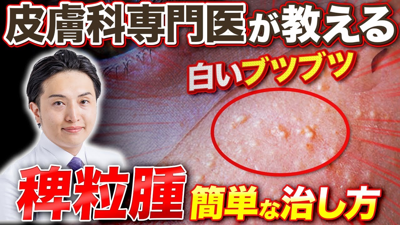 【治療映像あり】目の周りのブツブツ「稗粒腫」の治し方を皮膚科専門医が徹底解説! - YouTube 【治療映像あり】目の周りのブツブツ「稗粒腫」の治し方を皮膚科専門医が徹底解説! - YouTube