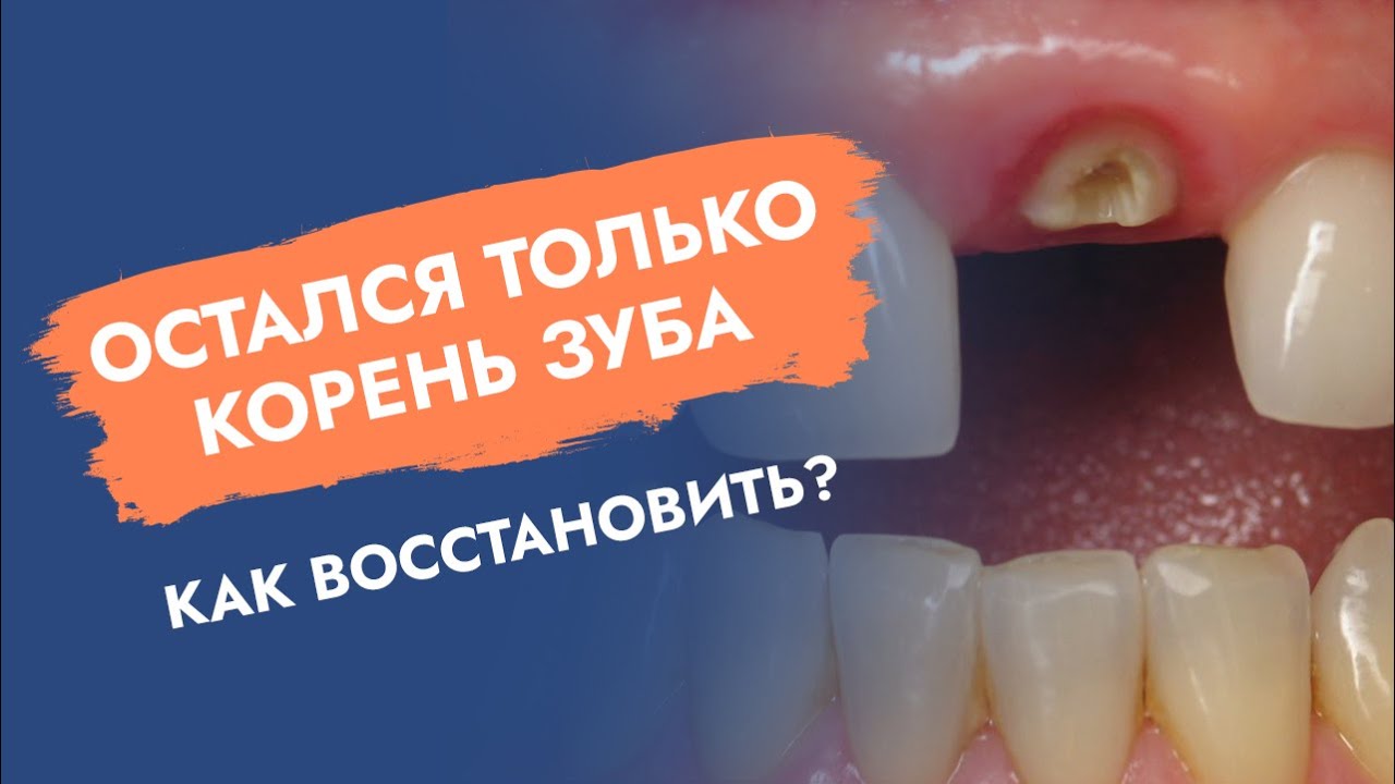 3 самых бюджетных способа восстановить зубы. Восстановление утраченных зубов