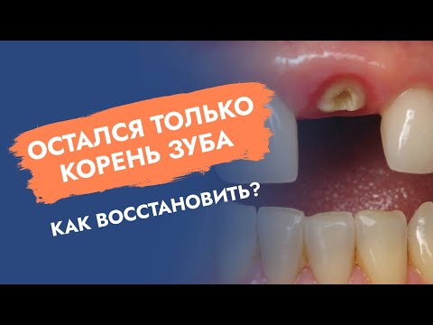 Видео: Масштабирование зубов и строгание корней: как они могут спасти ваши зубы