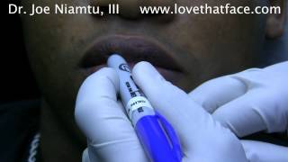 Lip Reduction: How much tissue do you remove? by Dr. Joe Niamtu, III