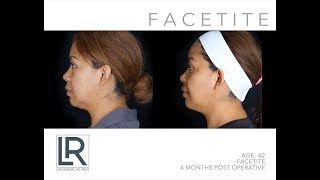 Non-Surgical Face Lift with FaceTite