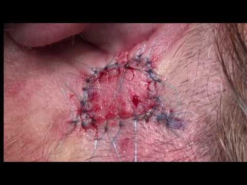 Video: Hemangioma Tulang Belakang - Rawatan, Hemangioma Kawasan Serviks Dan Toraks