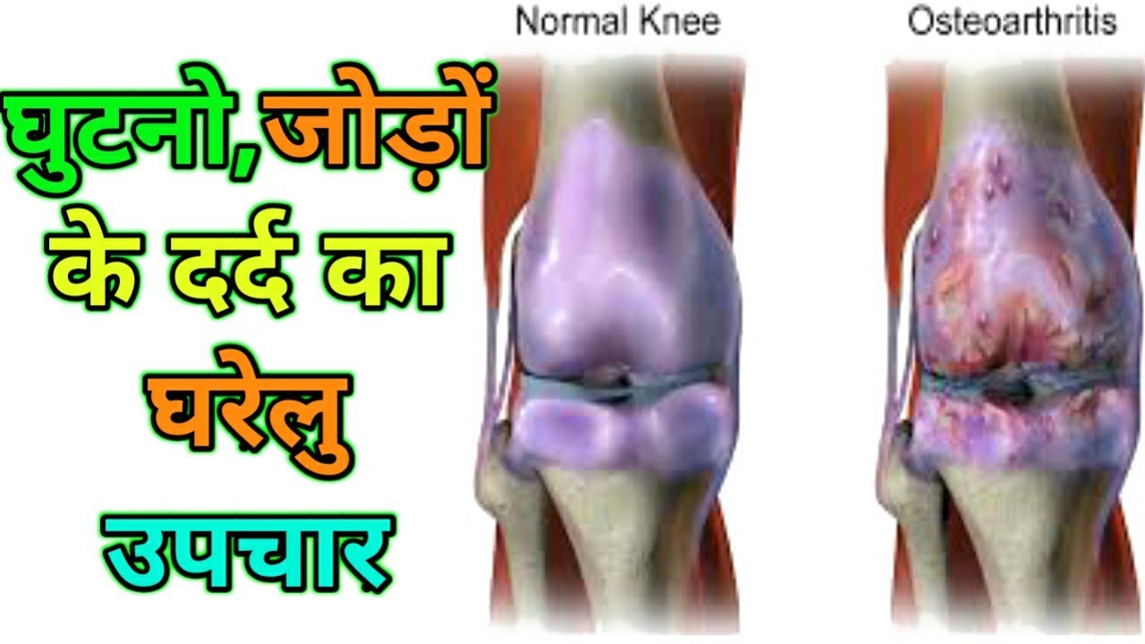 घुटनों और जोड़ों के दर्द का घरेलू इलाज Joint Pain Treatment In Hindi