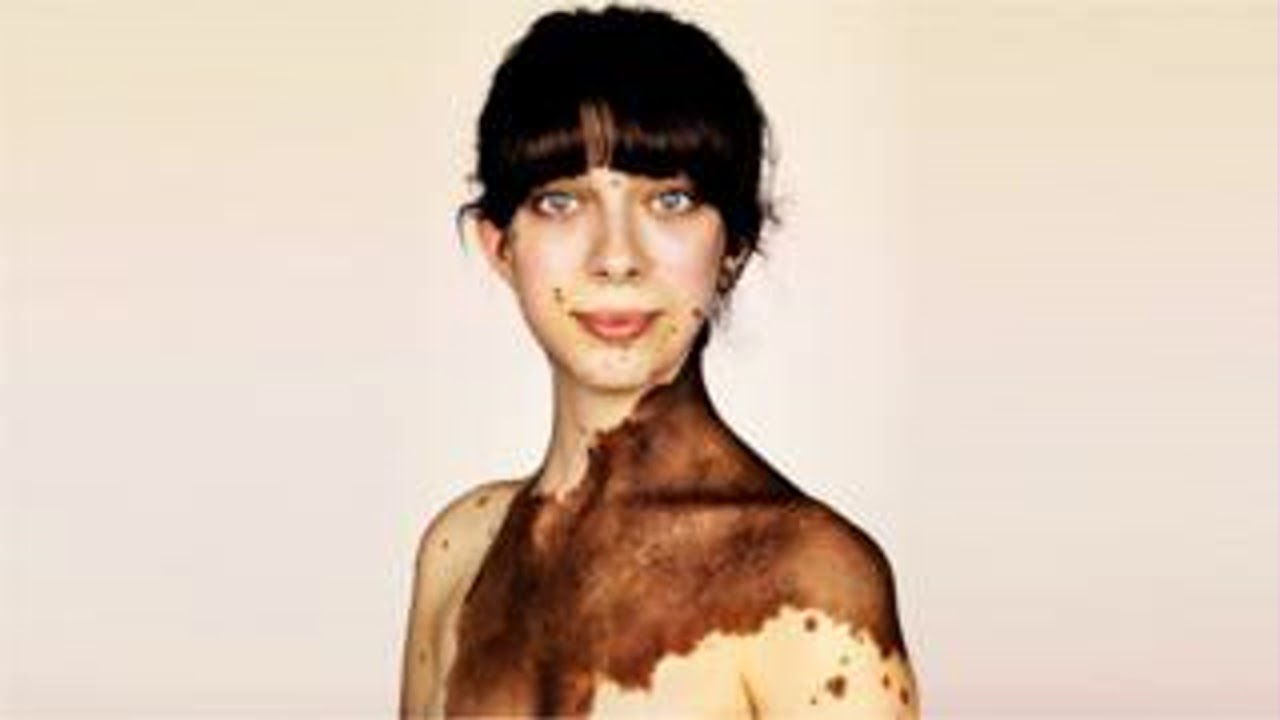 Очень много родинок: как это жить с редкой особенностью кожи - YouTube