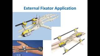 External Fixators In Distal Radius Fractures