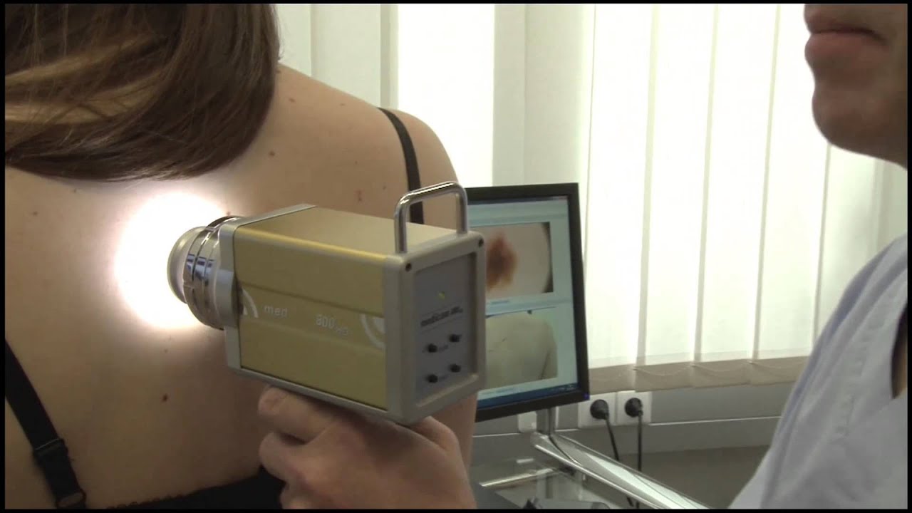 Computergestützte HD Hautkrebsvorsorge