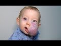 See 2yearolds incredible transformation after surgery to remove facial tumor