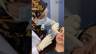 Under eyes filler - فيلر تحت العينين screenshot 2