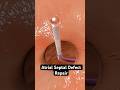 Repairing a hole in your heart (3D Animation)