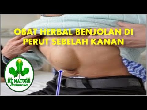 Obat Herbal Benjolan Di Perut Sebelah Kanan Youtube