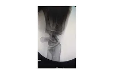 Scaphoid fracture percutaneous fixation