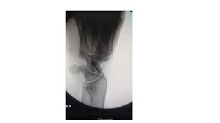 Scaphoid Fracture Percutaneous Fixation