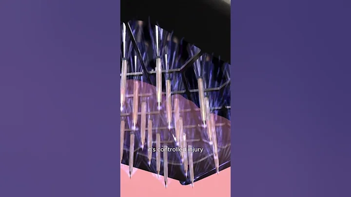 Morpheus8 & Collagen