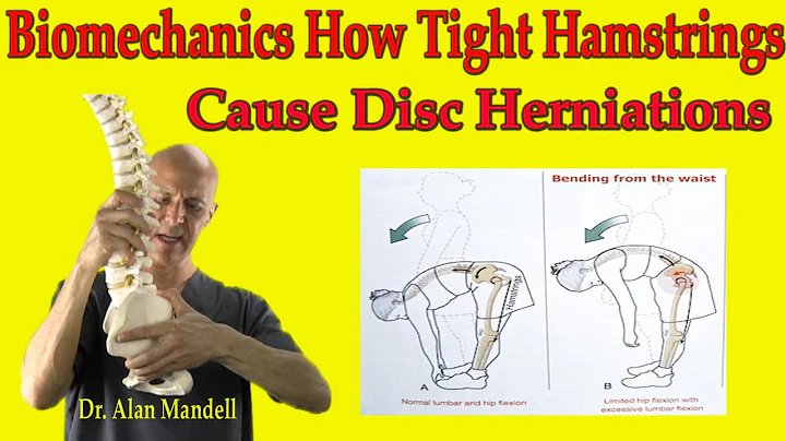Biomechanics How Tight Hamstrings Cause Disc Herniations - Dr Mandell