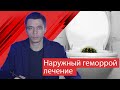 Наружный геморрой - подробное видео о лечении