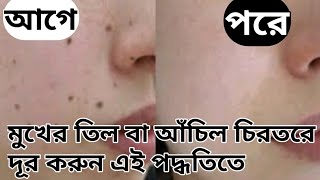 মুখের তিল বা আঁচিল চিরতরে দূর করার সহজ পদ্ধতি/মুখ থেকে বিভিন্ন দাগ ছোপ দূর করার উপায়/skin care video