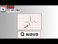 Day 6 pathological q waves on ecg  30day ecg challenge