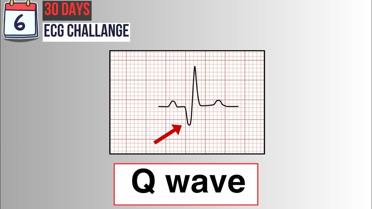 Day 6 pathological q waves on ecg 30 day ecg challenge youtube