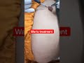 warts treatment #warts#viral#ytshorts