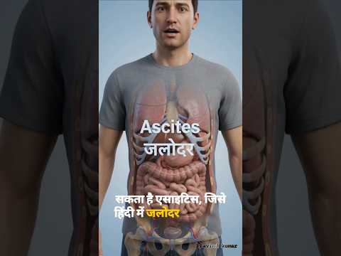 Ascites #shorts #medical #ai #aiknowledge #pravindkumar #facts