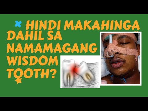 Video: Bakit Kailangan Ang Mga Ngipin Ng Karunungan At Dapat Itong Alisin, Kabilang Ang Sa Ibabang Panga