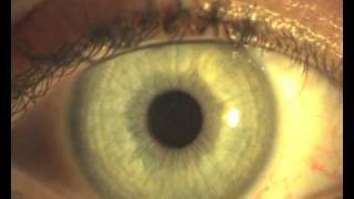 Lisi Iridologica Iridologia Naturopatica