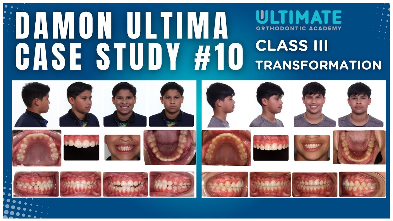 Class III Correction in 14 Months | Torque Control, Bracket Strategy & Efficient Mechanics