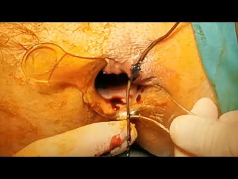 Video: Fistula - Vrste, Vzroki, Simptomi In Zdravljenje Fistul
