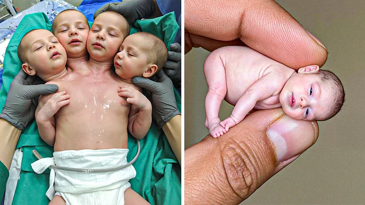 18 Strangest Babies You Won't Believe Actually Exist