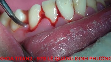 Hậu quả của việc vệ sinh răng miệng không tốt.