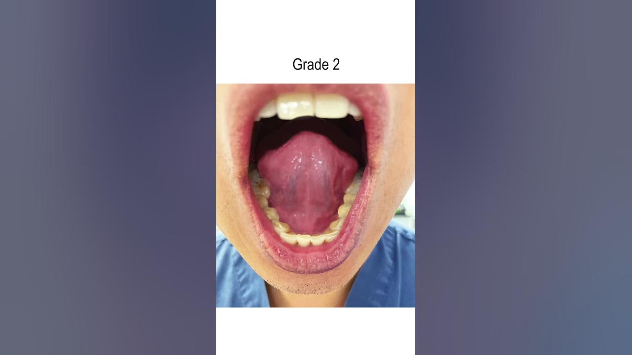 tongue-tie-severity-grades-1-4-tongue-range-of-motion-ratio-youtube