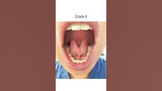 Tongue Tie: Severity Grades 1-4 (Tongue Range of Motion Ratio)