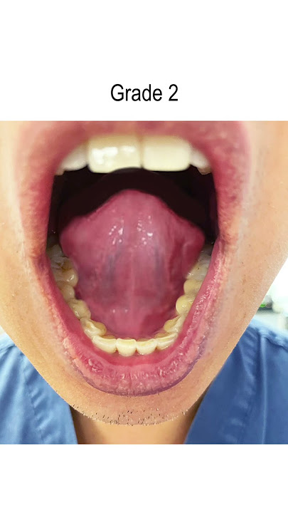 Tongue Tie: Severity Grades 1-4 (Tongue Range of Motion Ratio)