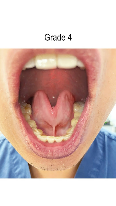 Tongue Tie: Severity Grades 1-4 (Tongue Range of Motion Ratio)