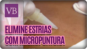 Quanto custa cada sessão de Micropuntura?