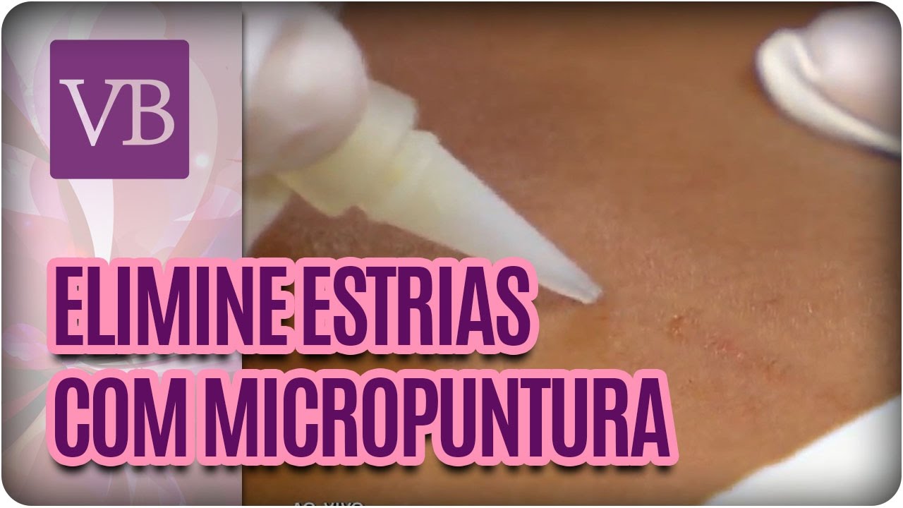 Tratamento de Estrias com Micropuntura - Você Bonita (18/01/17) vida saudável herbalife