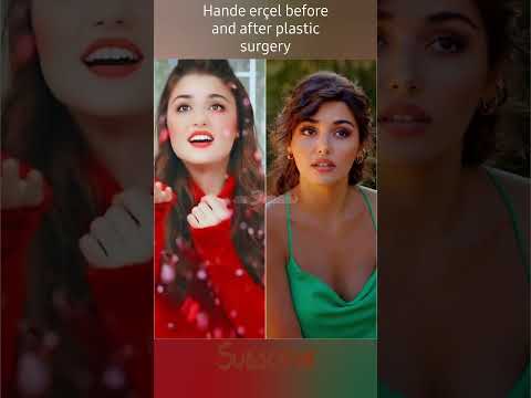 Turkish actress hande ercel before and after plastic surgery|Then and now|handemiyy|