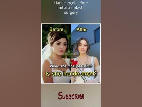 Turkish actress hande ercel before and after plastic surgery|Then and ...