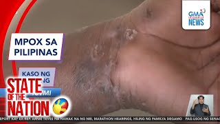 In Case You Missed It - MPOX sa Pilipinas; Kaso ng ketong; Bantay-taal | SONA