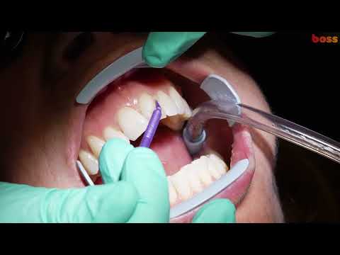 Bonding Attachments for Ormco Spark Clear Aligner- demonstration by Dr Vandana Katyal Orthodontist