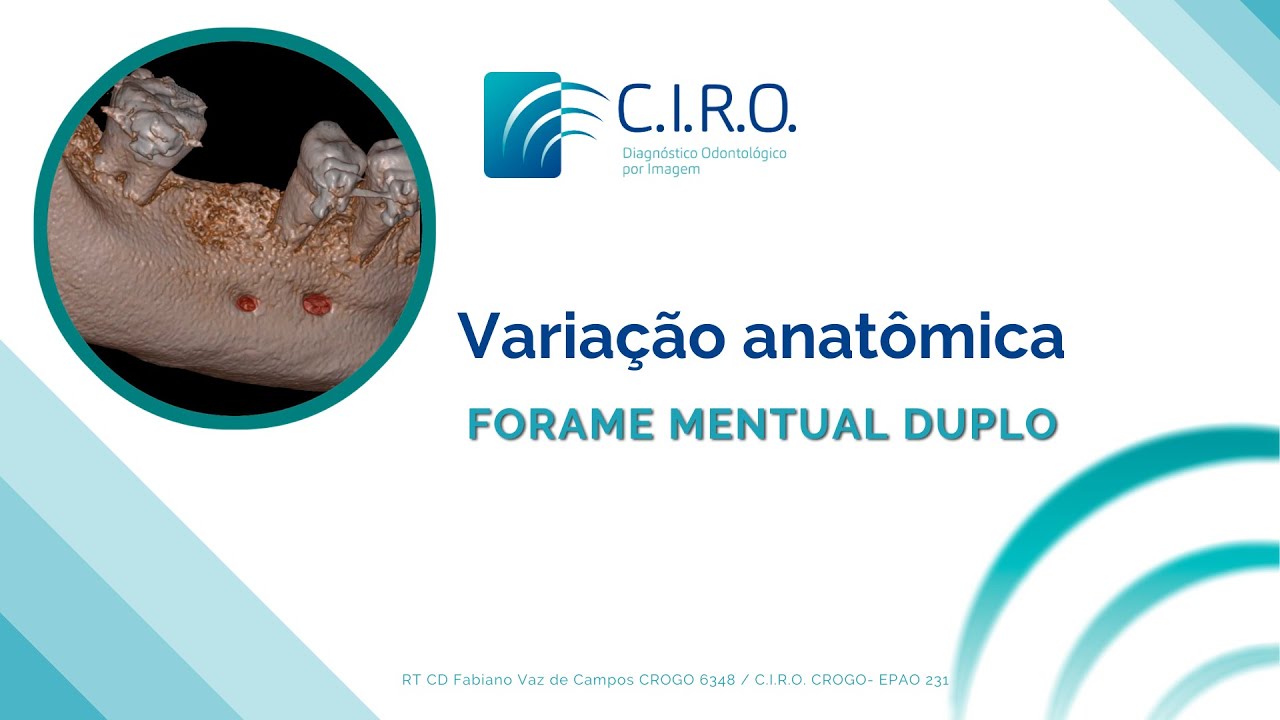 Variação anatômica: forame mentual duplo