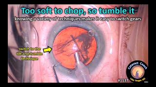 CataractCoach 1137: too soft to chop so switch to tilt-and-tumble phaco screenshot 4