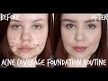 Acne Coverage Foundation Routine | Full Coverage for Cystic Acne/Scarring