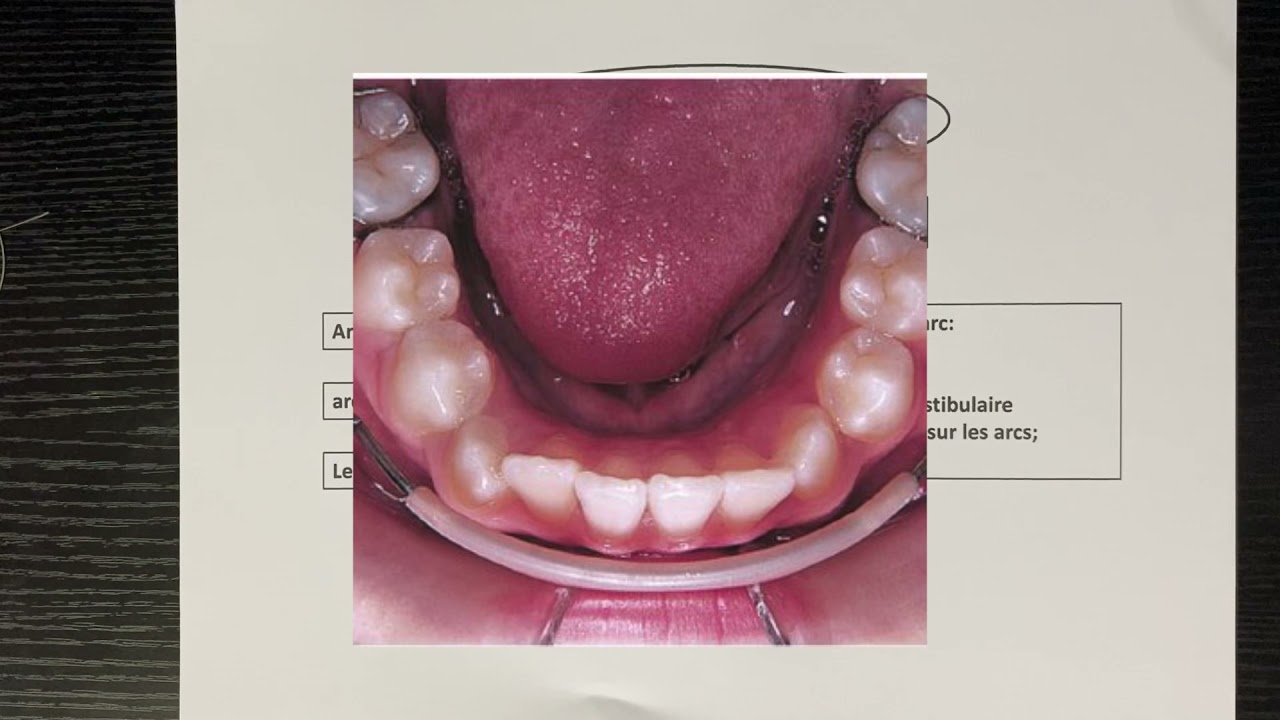 Introduction a la therapeutique fixe (ancrage) cours 4iem odf