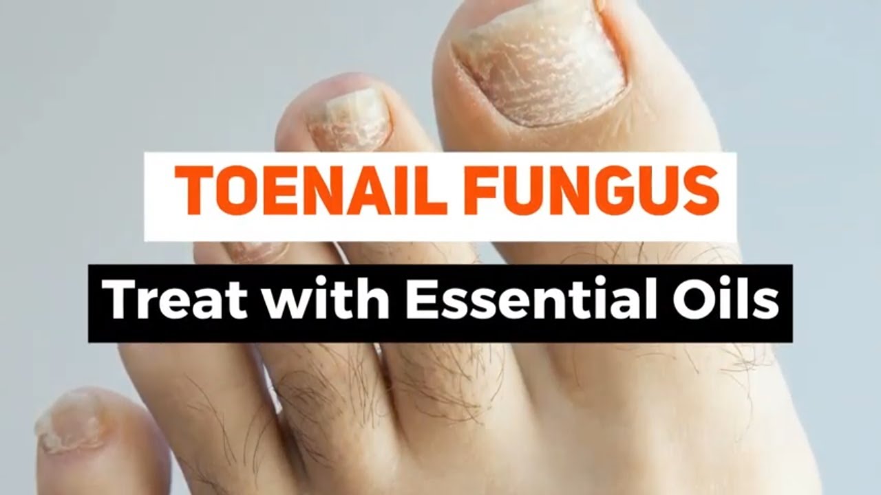 Top 10 Essential oils for toenail fungus treatment YouTube