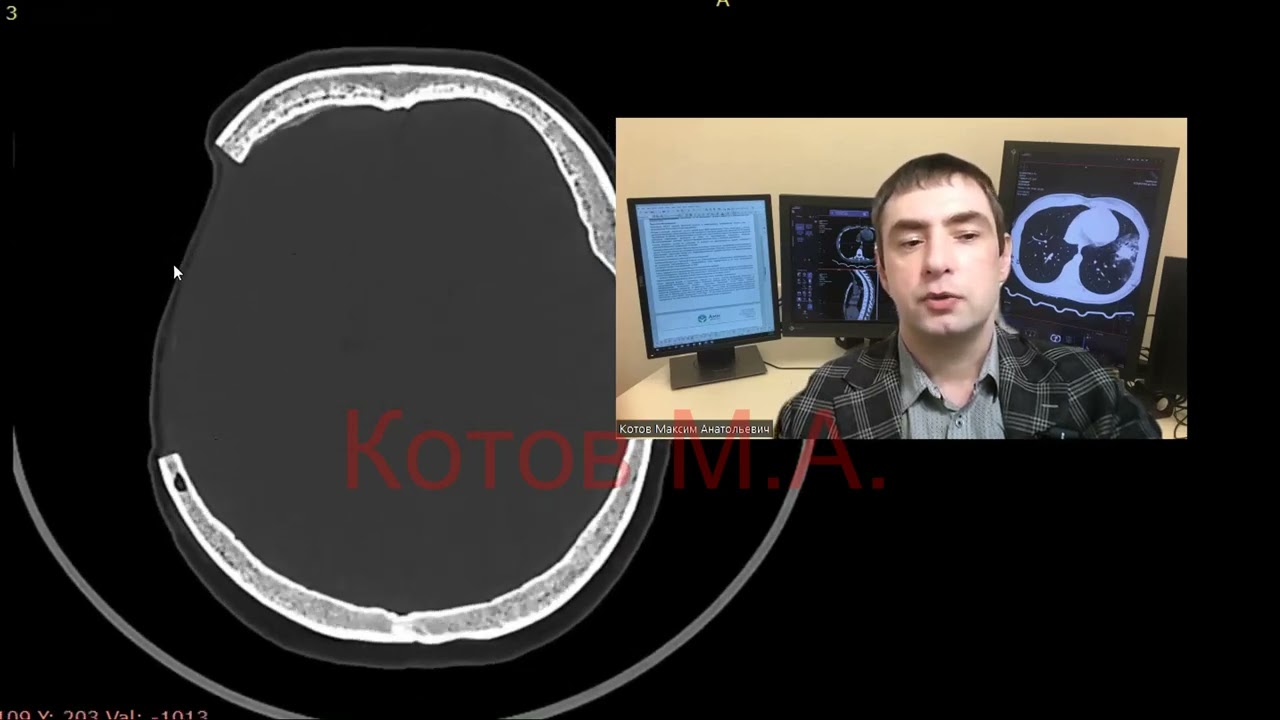 Краниопластическая трепанация черепа. Ролик №34