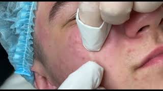 Acne removal on face. 顔のにきび除去 Part 4