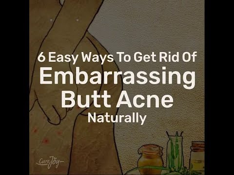  Easy Ways To Get Rid Of Embarrassing Butt Acne Naturally